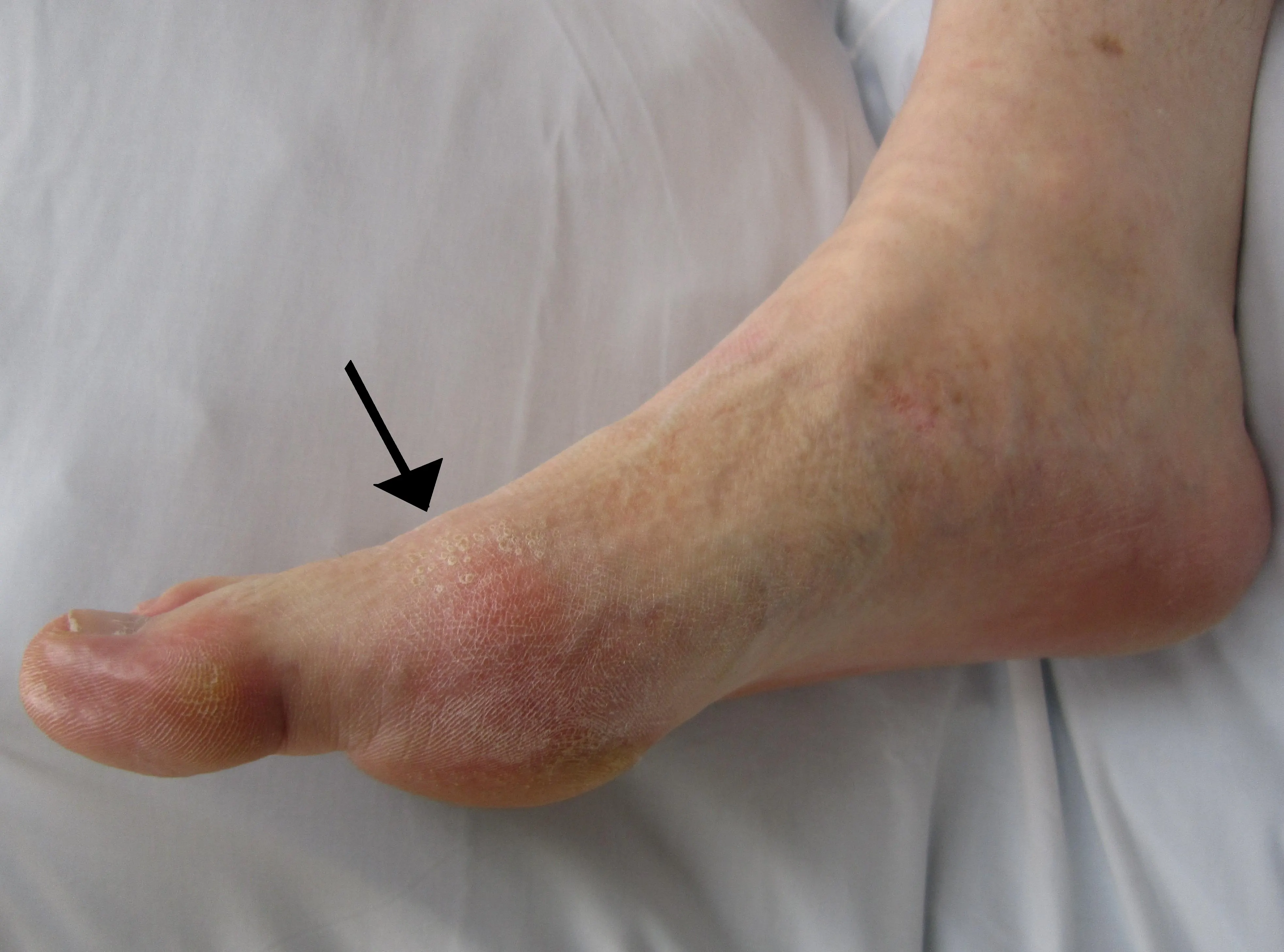 Clinical photo of a foot with a visible inflammatory change